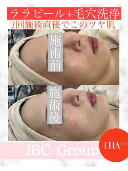 トータルサロンアイビーシー(トータルサロンIBC)/ツヤ爆弾!ララピール+毛穴洗浄