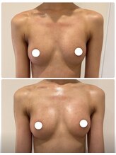 美人バスト 南森町店/バストアップ◇症例◇