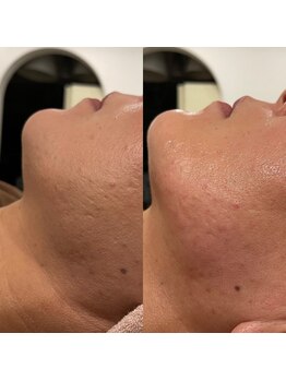 ビュウナ 銀座(BEAUNA)/カルテットモード全顔