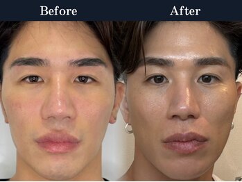 イロハ(IROHA)の写真/《美容男子/お肌をキレイにしたい男性はIROHAへ》毛開き・黒ずみ/凹凸肌/ニキビにお悩みの方に◎