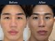 イロハ(IROHA)の写真/《美容男子/お肌をキレイにしたい男性はIROHAへ》毛開き・黒ずみ/凹凸肌/ニキビにお悩みの方に◎