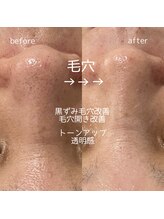 ホーミー(HOMIE)/毛穴ケア