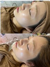 マホロバ(mahoroba)/ララピールビフォーアフター