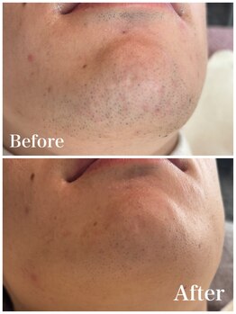 ピュア 川越店/メンズひげ脱毛