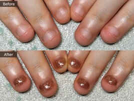 深爪矯正の施術