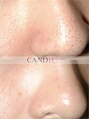 キャンディ 栄店(CANDi)&nbsp;毛穴開き 徹底改善