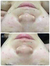 メイユール(MEILLEUR)/光フェイシャル18回