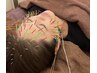 【★美容鍼ハリネズミ女優コース】超小顔矯正効果＋美容鍼１００本に頭皮ケア