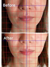 ハリキュア(Hari-Cure)/美容鍼Before After