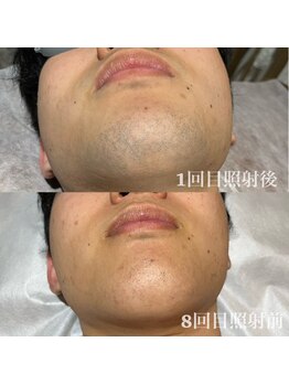 ゆいまーるはうす/メンズヒゲ脱毛8回目