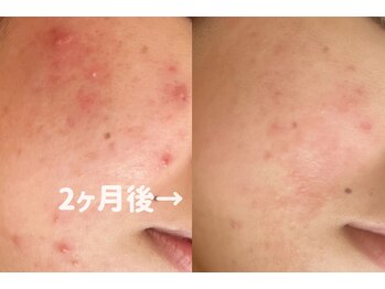 れふぇるん 足利店/20代 ニキビケア 施術4回