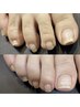 【巻き爪牽引チップ補正】お色不要で補正ケアだけしたい方向け！(片足¥11000)