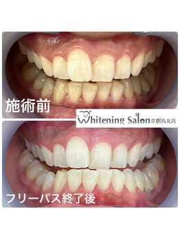 ホワイトニングサロン 京都烏丸店/ホワイトニング施術例