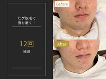 ステイゴールド 新百合ヶ丘(STAY GOLD)/おヒゲ脱毛の経過☆