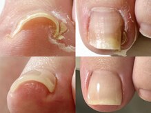 ハッチネイル(HACCI nail)