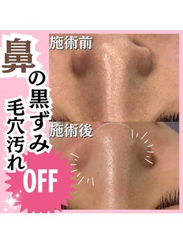 ホワイトワックス 名古屋金山店(WHITE WAX)/鼻の黒ずみ・毛穴汚れもOFF