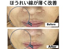 グレースティー 森町 箕面/ほうれい線のしわが薄く改善★