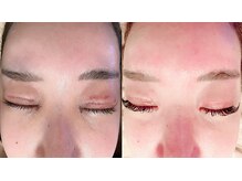 術後ケアのビフォーアフター、驚きの効果！