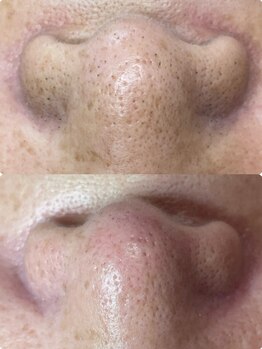 ルル(LULU.)の写真/【頑固な小鼻の黒ずみ・ざらつきに】汚れ分解＆毛穴引き締めのｗパックでツルツルな小鼻へ。