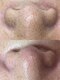 ルル(LULU.)の写真/【頑固な小鼻の黒ずみ・ざらつきに】汚れ分解＆毛穴引き締めのｗパックでツルツルな小鼻へ。