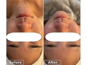 スリーウェルスラボ 恵庭店(THREE wealth lab)/ハーブピーリング症例