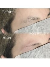 サロンロン 横浜関内(SALON RON)/眉毛脱毛/美容電気脱毛