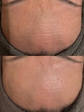 ラノン(LANON)/ビフォーアフター19