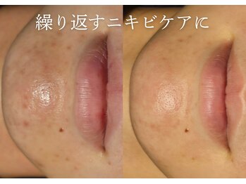 アマランサス(Amaranthus)/ニキビを根本ケアで肌荒れ卒業