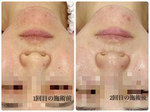 シルク(Cilk)/2週間に1度のハーブ施術！