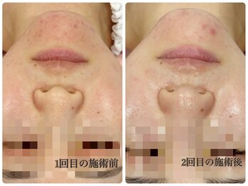 シルク(Cilk)/2週間に1度のハーブ施術！