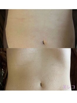 ボディケア クレア/ハイパーナイフ・痩身