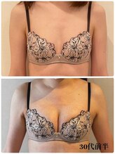 リール 新宿店(RIRE)/30代前半　バストアップ症例