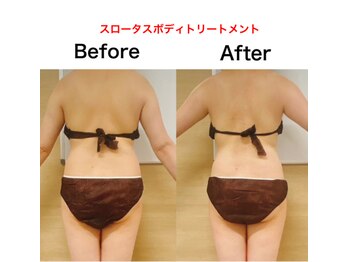 エフクレール(Ef Clair)/スロータス施術ビフォーアフター