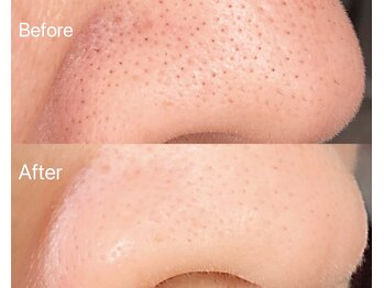 リアン(Lien)/毛穴洗浄ハイドロスプラッシュ