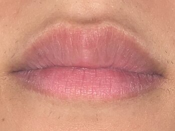 フェリス(FELIZ)の写真/乳輪・脇下・唇・肘・ひざ・首の後ろ・ヒップ下…気になる黒ずみに！結果重視の最新ケア！