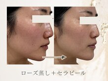 アネラボーテ(Anela Beaute)/ローズ蒸し＋セラピール