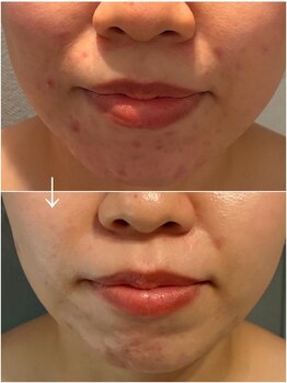 ハチ(Hachi)/肌質改善