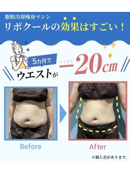 オレッド 多賀城(Oreddd)の写真/【多賀城駅から５分】理想のボディを目指す♪脂肪冷却を贅沢２カップ!上半身～下半身迄、脂肪を分解◎