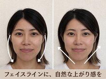 ピュアハリ/たるみ・ほうれい線専門美容鍼
