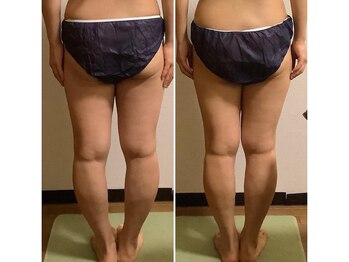 カレン/深層筋膜リリース