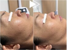 リシェス(Richesse)/肌荒れケアハーブ★初回¥9990