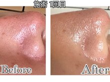 シード(SHE°)/REVIハーブピーリング