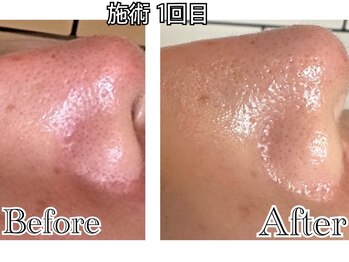 シード(SHE°)/REVIハーブピーリング