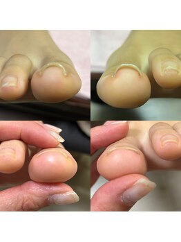 マニュコクーン(ManuCocoon)/爪育成 深爪 巻き爪 大阪