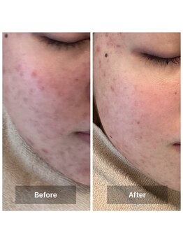 モカ 天王寺店(MOKA)/剥離4回　ホホニキビ　ハーブ