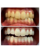 ルフレ(Reflet)/白い歯で第一印象アップ☆