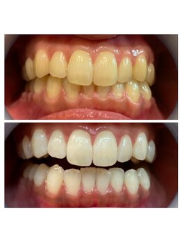 ルフレ(Reflet)/白い歯で第一印象アップ☆