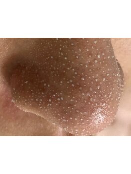 毛穴ケアをしたい