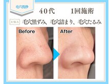 リュミエール(Lumiere)の雰囲気（夏オススメ！黒ずみ・角栓・毛穴たるみを徹底除去◎一回施術効果）