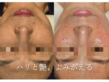 アマランサス(Amaranthus)/ハリと弾力で若見え肌へ